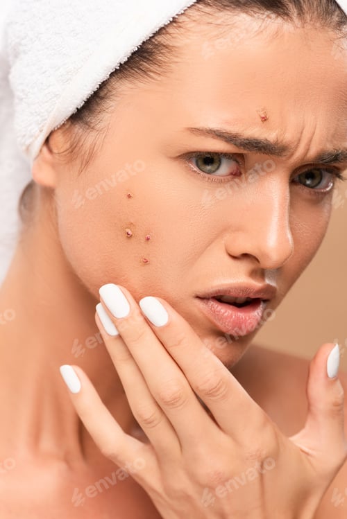 Preview: upset woman in towel touching face with acne isolated on beige