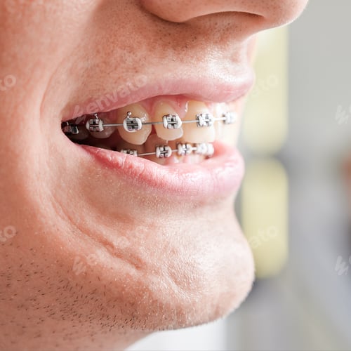 Preview: Macro photography of human's mouth with metal braces on teeth