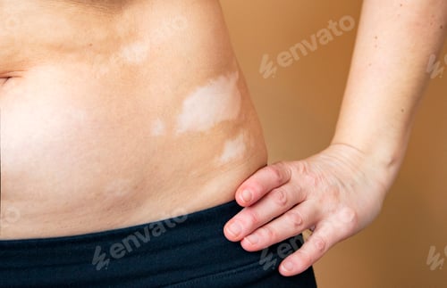 Preview: Vitiligo on the belly of a woman.