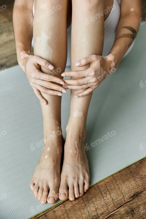 Preview: Vitiligo woman practices yoga in modern apartment