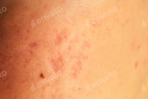 Preview: post-acne, scars and red festering pimples on the skin of the face