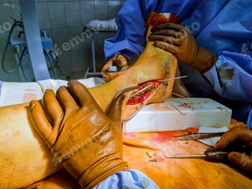 Preview: Following a leg fracture metal plate is surgically placed by doctors