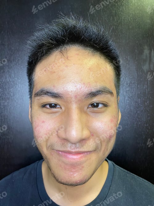 Vista previa: Portrait of an Asian teenager with serious acne problems and deep scarring