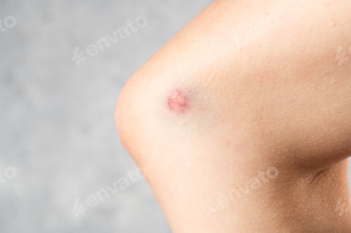 Preview: big bruise on the girl's skin close up. Skin hematoma. Purple wound. Skin injury. Skin trauma.