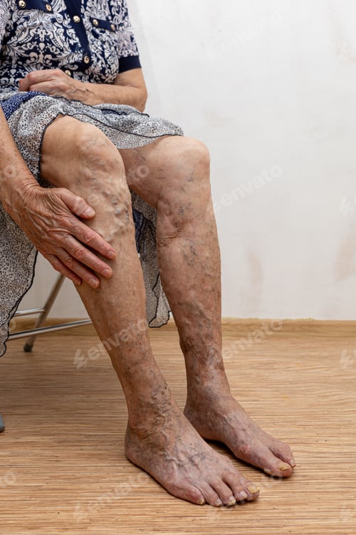 Preview: Elderly woman show bare legs with varicose veins inflammation. Need laser surgery. Thrombophlebitis