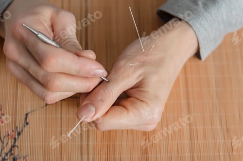 Preview: Man using acupuncture treatment for pain relief
