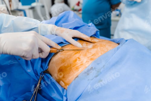 Preview: Surgeon removes belly fat Abdominoplasty Reduce abdomen Cellulite