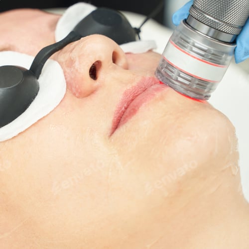 Preview: Close-up of laser skin treatment on adult female during facial procedure