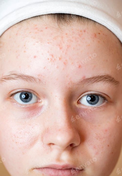 Preview: Teen girl with acne problem.