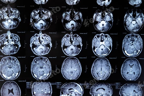 Preview: mri with brain tumor. Magnetic resonance imaging.