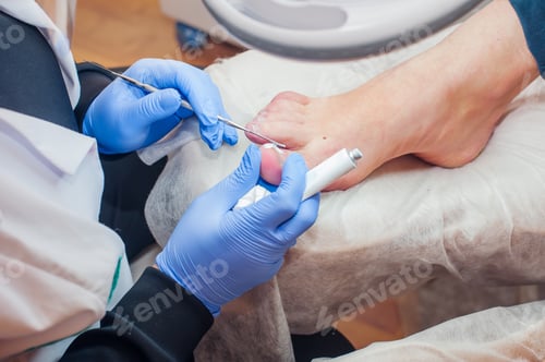 Preview: Podology treatment. Podiatrist treating toenail fungus. Doctor applying cream on removed ingrown nai