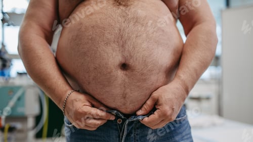 Preview: Close up of abdomen of overweight patient. High waist circumference of obese man, belly fat. Concept