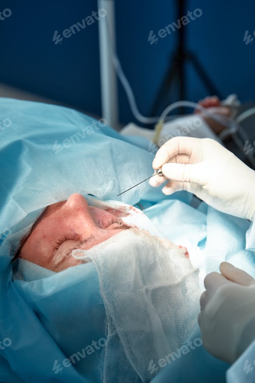 Preview: Close up of the face of a patient who is undergoing blepharoplasty. The surgeon cuts the eyelid and