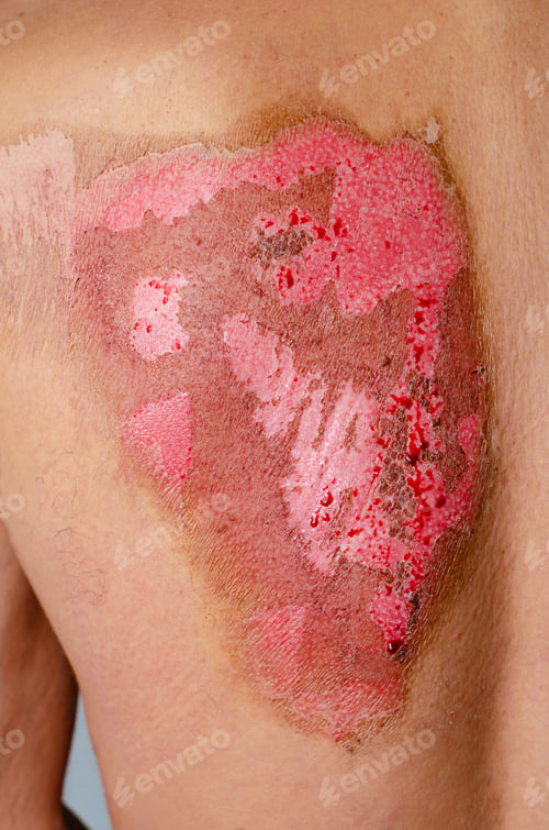 Preview: Second-degree burns on male back caused by heat. Medical and healthcare concept.