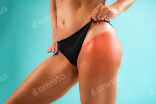 Preview: Sunburn shows as redness on a body from excessive UV exposure