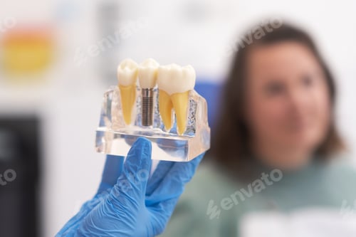 Preview: close-up patient dental implant treatment plan. The focus is teeth implant model in dentists hand
