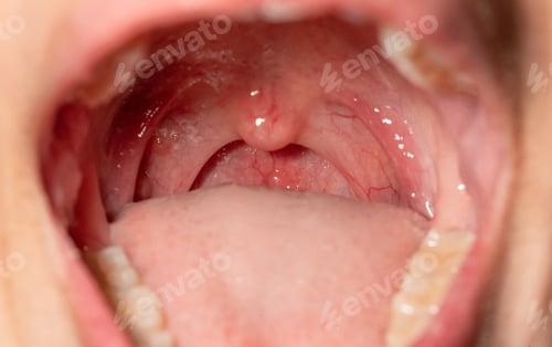 Preview: Sore throat with throat swollen. Closeup open mouth with posterior pharyngeal wall swelling