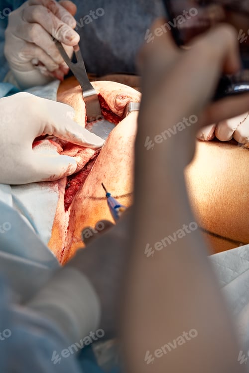 Preview: The doctor performs an operation to reconstruct the female breast. Close-up of plastic surgeon