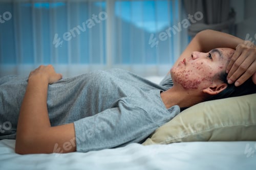 Preview: Pillows Cause Acne, Acne on Your face might be suffering when you rest your he