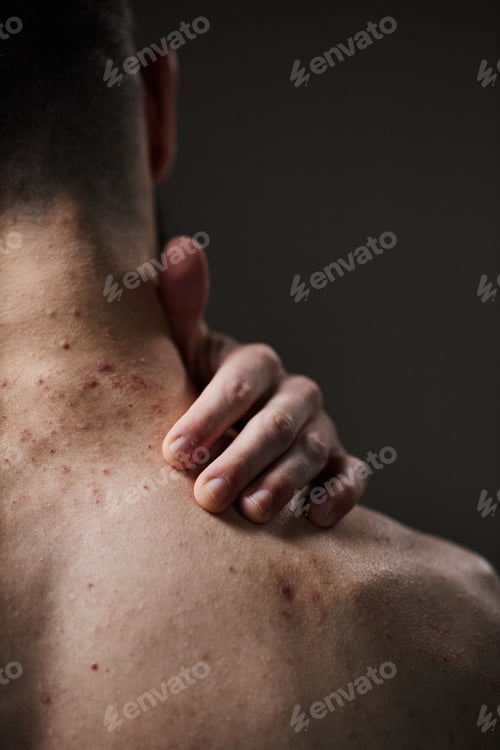 Preview: Young Adult Man Touching Neck with Acne