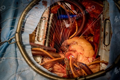 Preview: Due to a malfunctioning heart valve, open heart surgery is required for valve replacement in the