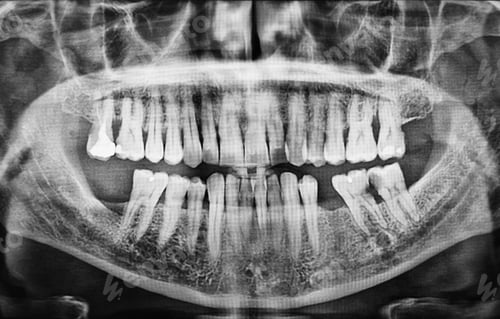 Preview: Molar caries x-ray dentist clinic diagnosis. Health care radiography background skull