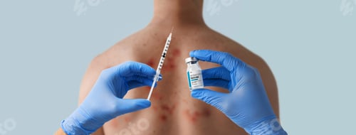Preview: Doctor's hand holding monkeypox vaccine with male back affected by blistering rash because of
