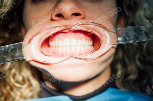Preview: Young woman getting braces put on teeth