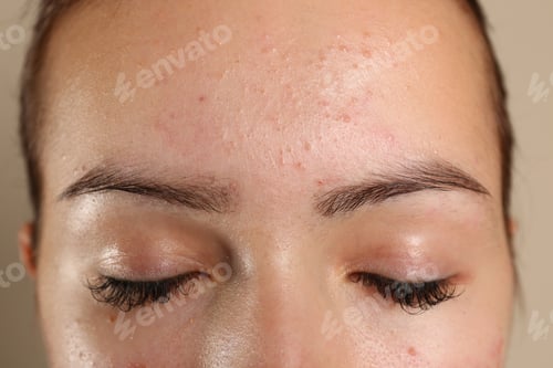 Preview: Teenage girl with acne problem on beige background, closeup