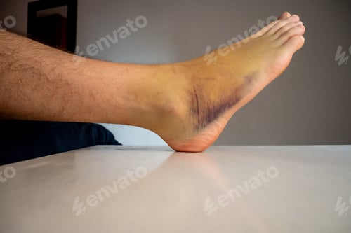 Preview: Right Foot Bruise, also known as Contusion on a Large Area with