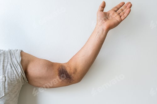 Preview: injury ligament arm bruise