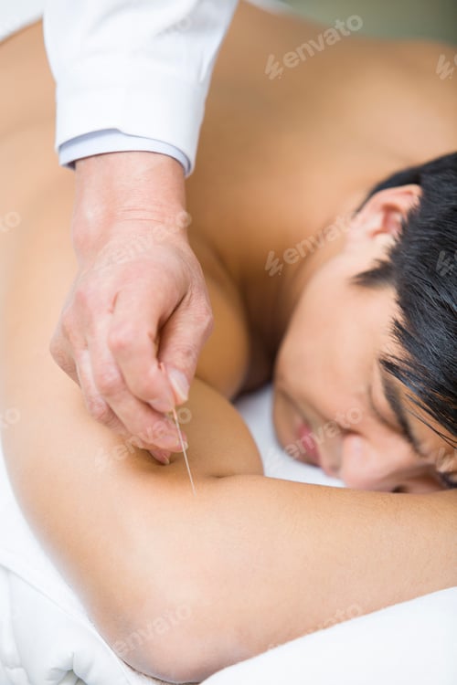 Preview: Patient receiving acupuncture
