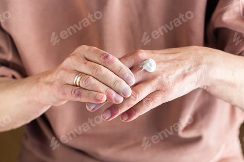Preview: Applying ointment to hands with atopic dermatitis, eczema, allergy