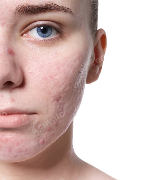 Preview: Young woman with acne problem on white background