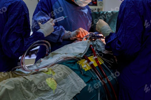 Preview: Open heart cardiac bypass surgery in operation room Doctors team wear blue coat perform heart