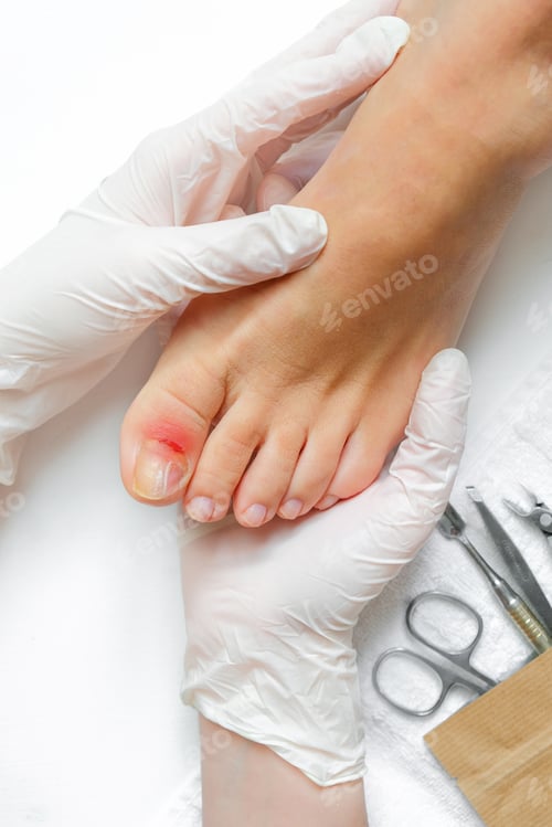 Preview: Pedicure, podologist. Patient on medical pedicure procedure, nail disease, cholesis detachment of th