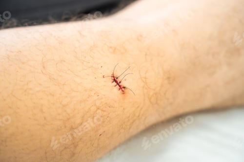 Preview: Fresh wound with stitches after skin operation. Removal of skin tumors