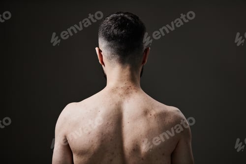 Preview: Young Adult Man Showing Back with Skin Condition at Dermatologist