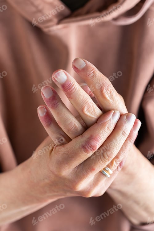 Preview: Woman hands with atopic dermatitis, eczema, allergy reaction on skin