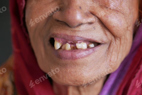 Preview: close up of senior women's dental caries and some broken teeth