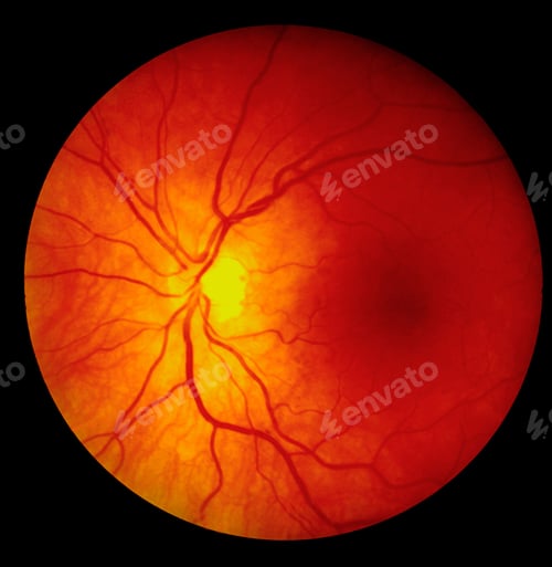 Preview: Fundus photography - Retina