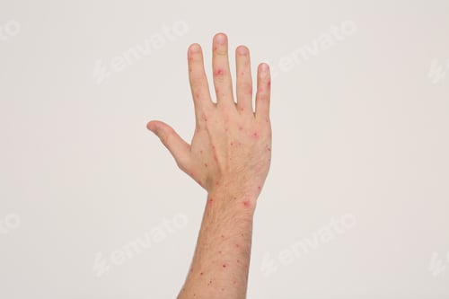 Preview: Man with rash suffering from monkeypox virus on beige background, closeup