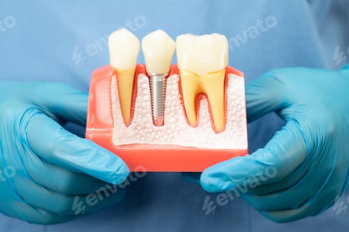 Preview: Asian dentist holding dental implant, artificial tooth roots into jaw