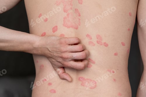 Preview: Psoriasis Vulgaris, skin patches are typically red, itchy, and scaly.