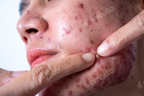 Preview: Acne on face because the disorders of sebaceous glands productions. Acne or a Cosmetic Allergy.