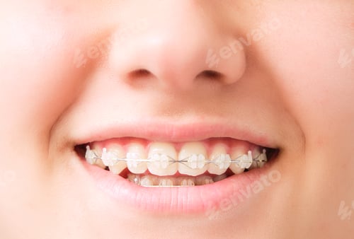 Preview: smiling mouth with dental aligner