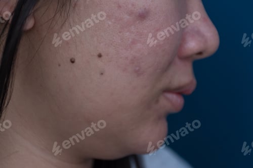 Preview: close up black hair female on beside shot with allergic skin face