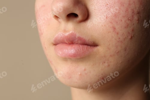 Preview: Teenage girl with acne problem on beige background, closeup