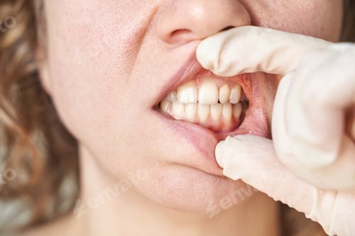 Preview: Female Caucasian adult dental examination with gloved hands close up teeth