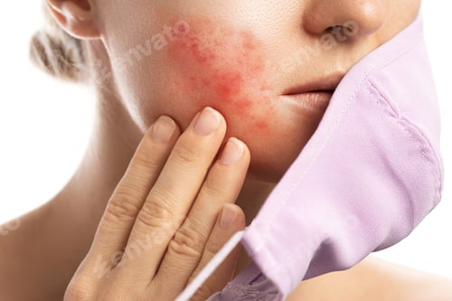 Preview: Maskne - acne breakouts from wearing a face mask